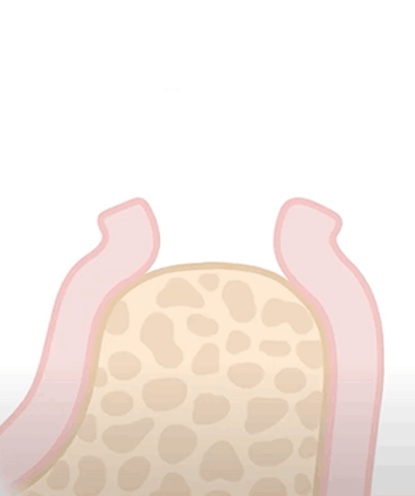 Ceramic implant procedure
